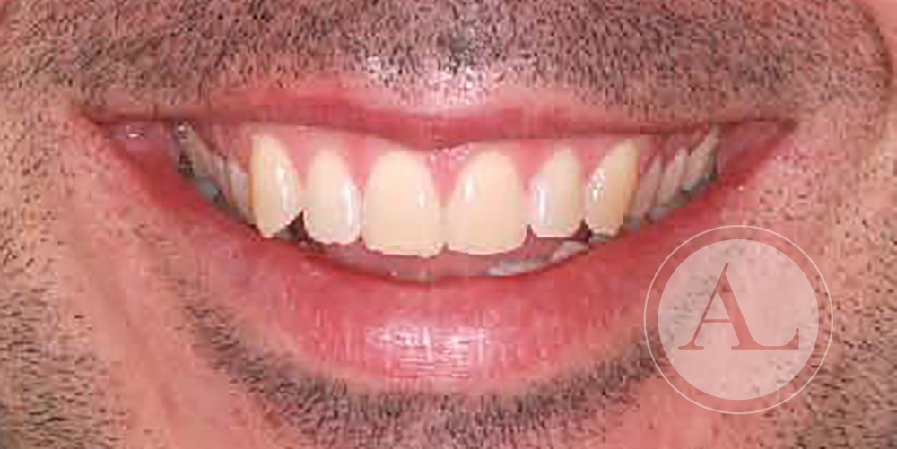 Ortodoncia en adulto Clínica Antonio Lucena