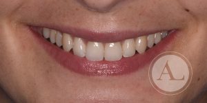 Tratamiento de ortodoncia invisible en Clínica dental Antonio Lucena