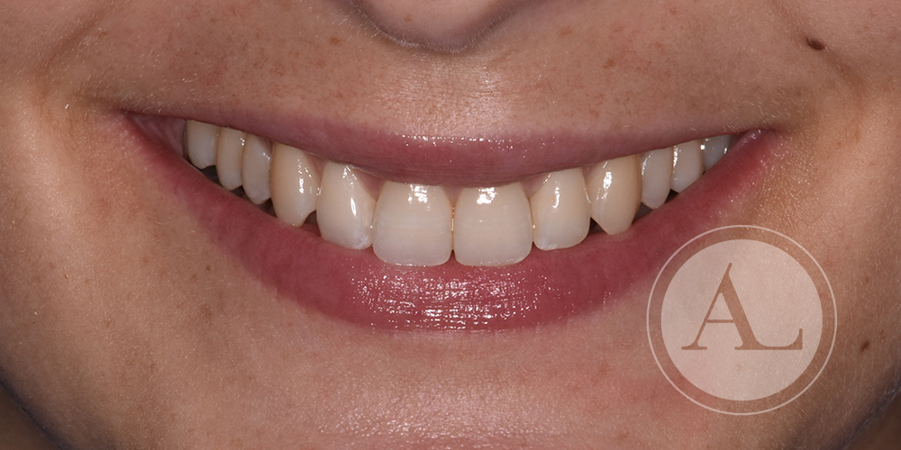 Tratamiento de ortodoncia invisible en Clínica dental Antonio Lucena