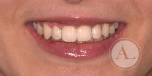 Mejora de estética dental en Clínica Antonio Lucena