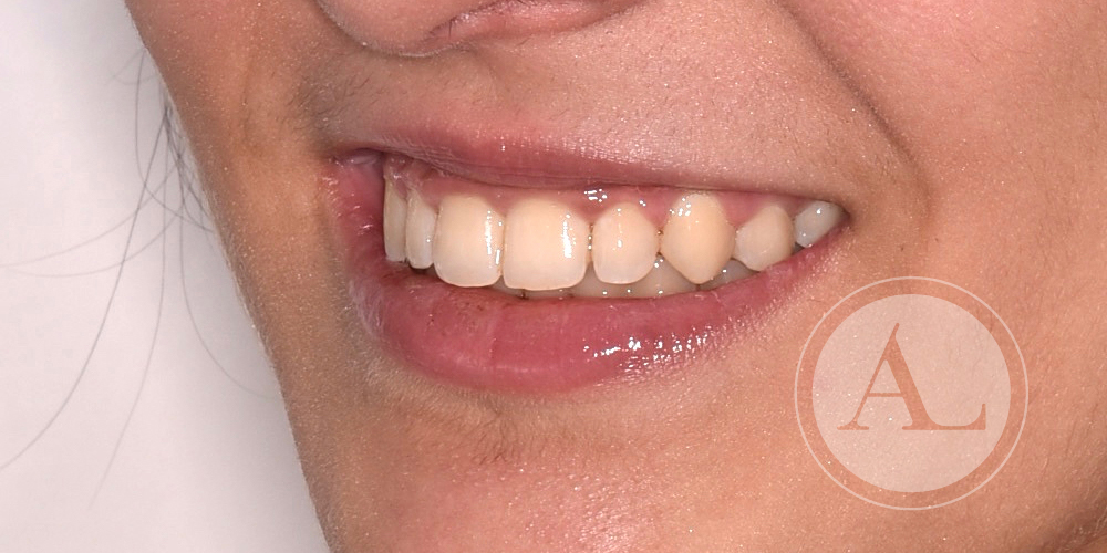 Ortodoncia con aparatos fijos clínica dental Antonio Lucena