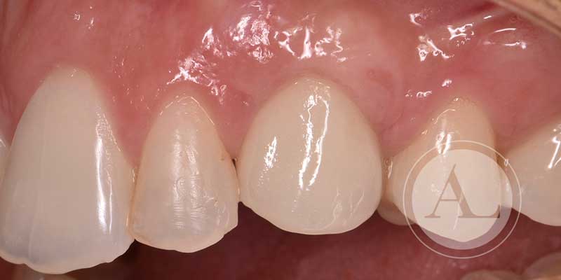 Implante dental Córdoba