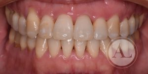 Tratamiento periodontal en paciente adulta Antonio Lucena