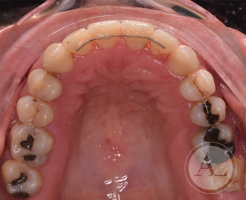 Corrección estética Clínica Dental Antonio Lucena