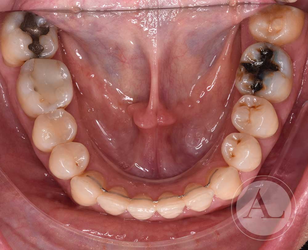 Caso tratamiento de ortodoncia Antonio Lucena
