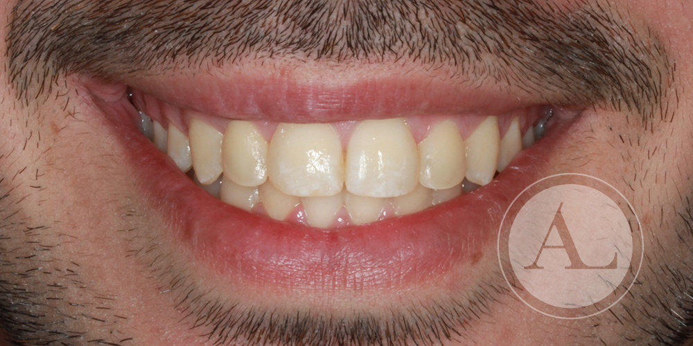 Final tratamiento de ortodoncia