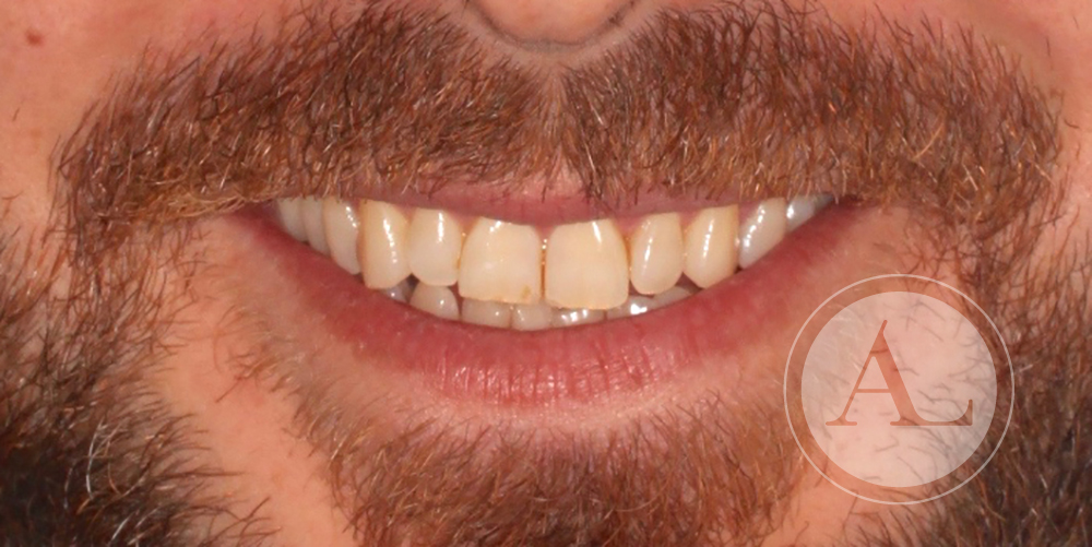 Apiñamiento dentario inferior