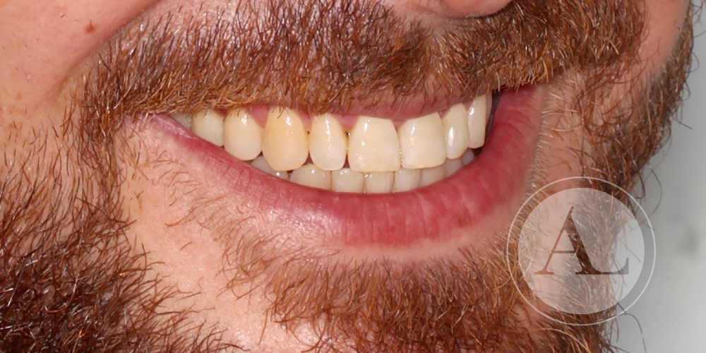 Correcta mordida tras ortodoncia Antonio Lucena