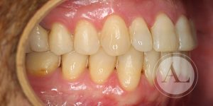 Ortodoncia para solucionar apiñamiento dental Antonio Lucena