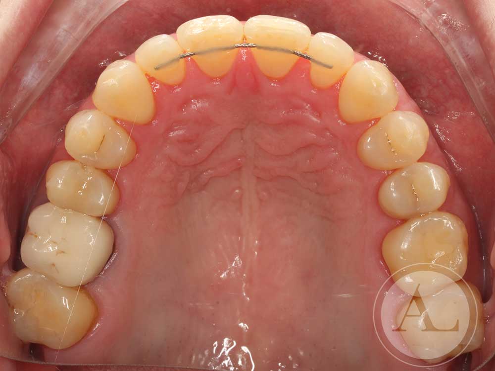 Resultados de ortodoncia Córdoba