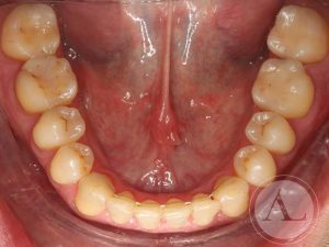 Resultados tras realizar un tratamiento de ortodoncia Antonio Lucena