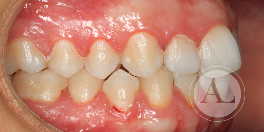 Tratamiento de ortodoncia en paciente joven