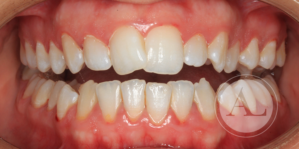 Análisis previo a tratamiento de ortodoncia