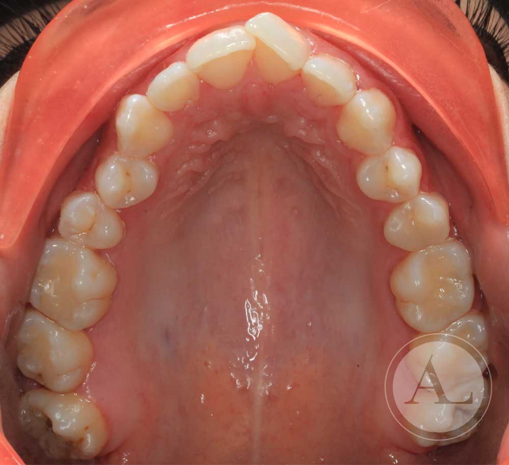 tratamiento de ortodoncia en paciente adulta