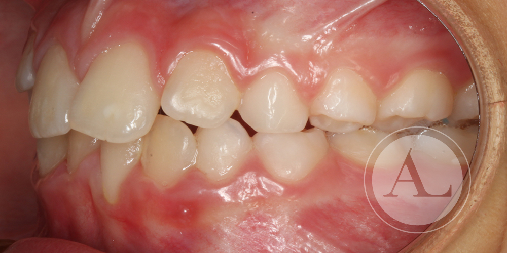 Alineación de dientes paciente 7 años