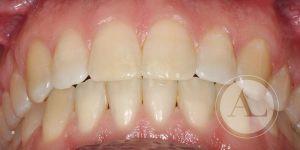 Finalización de tratamiento ortodoncia