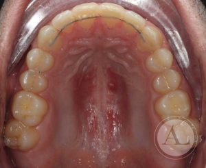 Finalización tratamiento de Ortodoncia