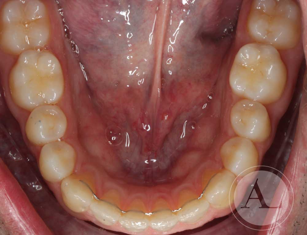 Finalización tratamiento de Ortodoncia Clínica Antonio Lucena