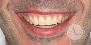 Ortodoncia para corregir la función masticatoria