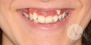 Ortodoncia en clínica Antonio Lucena
