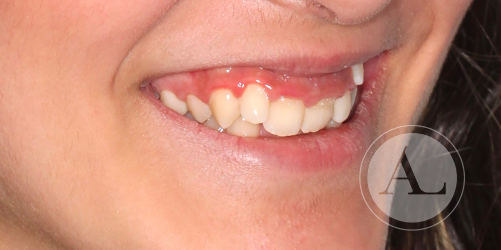 Ortodoncia sin extraer ningún diente
