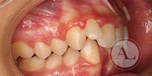 Caso de ortodoncia en adulto