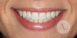 Ortodoncia con brackets de zafiro en Clínica Dental Antonio Lucena