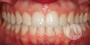 Resultado de ortodoncia Antonio Lucena