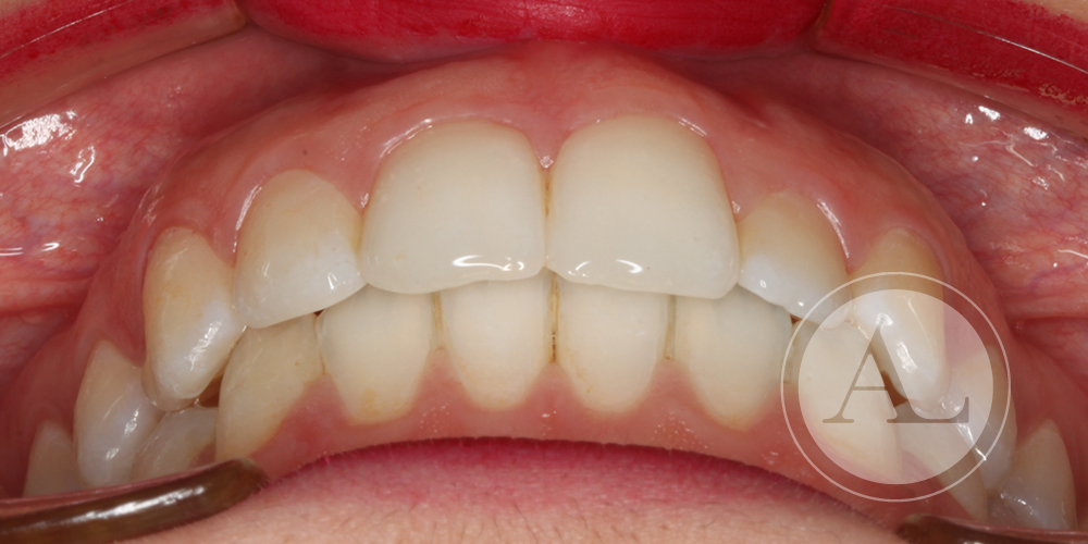Final de tratamiento de ortodoncia Clínica Antonio Lucena