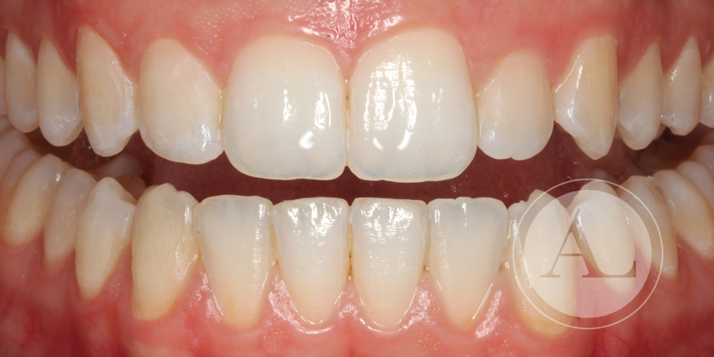Resultado tratamiento de ortodoncia Clínica Antonio Lucena