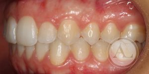 Tratamiento de ortodoncia Córdoba