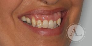 Caso de ortodoncia en paciente adulta