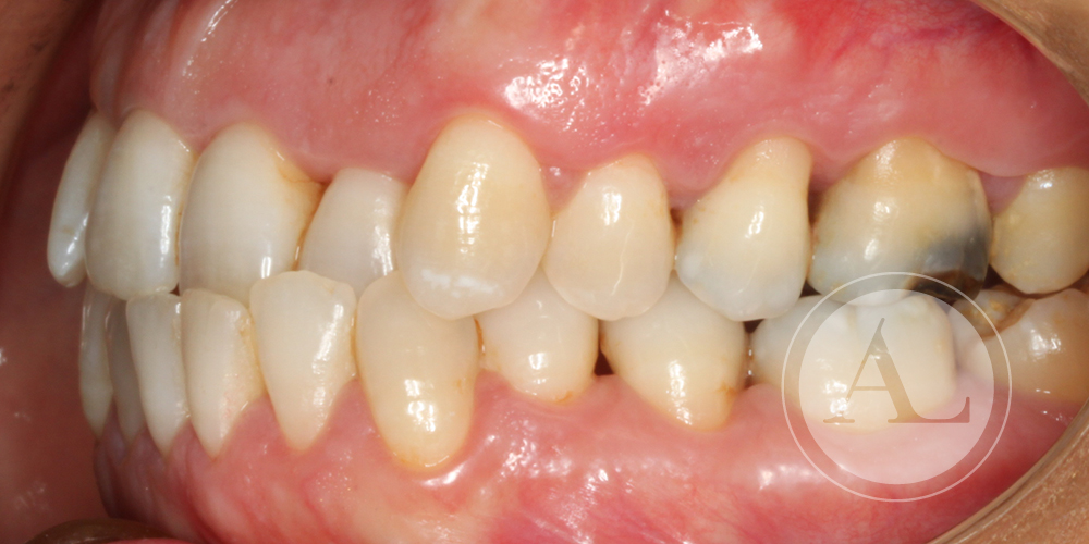 Tratamiento periodontal Clínica Priego de Córdoba