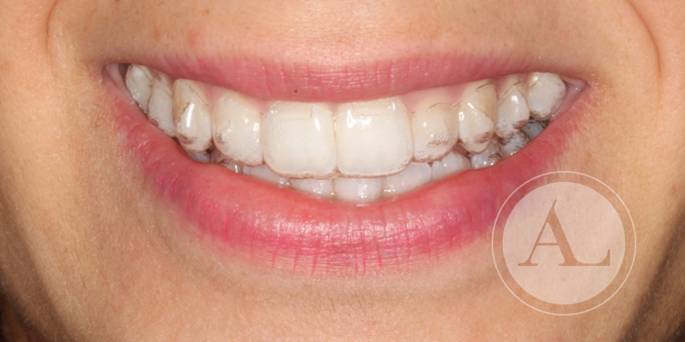 Tratamiento de ortodoncia transparente