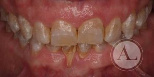 Tratamiento ortodoncia Antonio Lucena