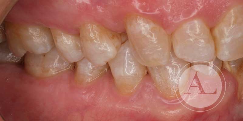 Desgaste dental Clínica Antonio Lucena