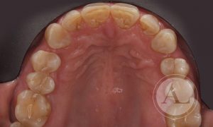 Tratamiento de ortodoncia invisible Antonio Lucena