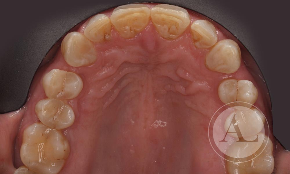 Tratamiento de ortodoncia invisible Antonio Lucena