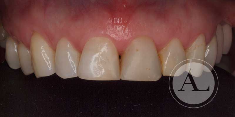 Desgaste dental Antonio Lucena