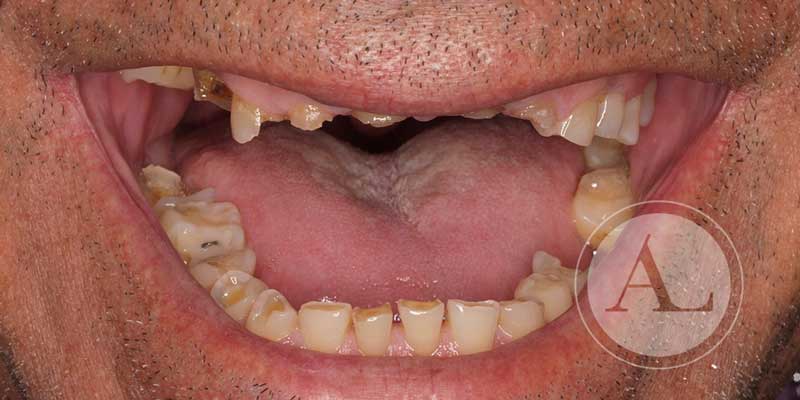 tratameinto dental complejo Antonio Lucena
