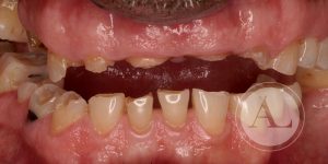 implante dental Clínica Antonio Lucena