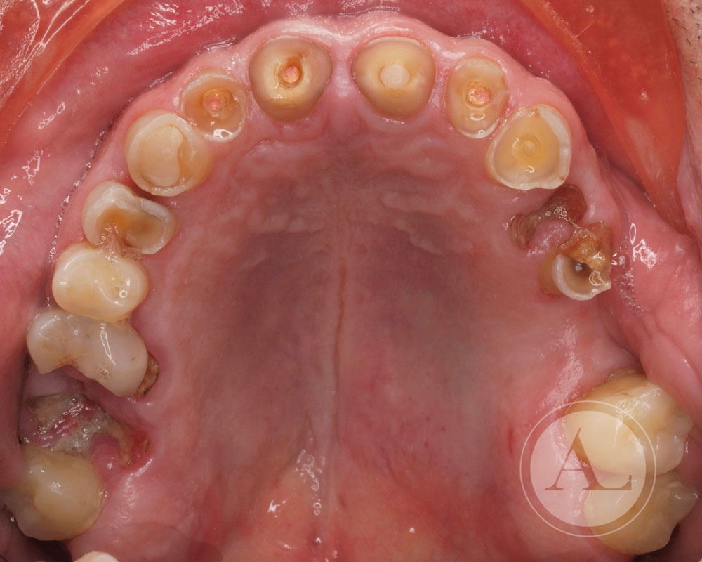 implantes dentales Antonio Lucena