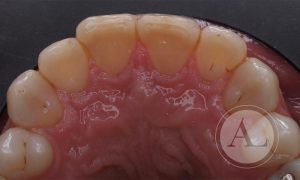 Tratamiento carillas de cerámica Clínica dental Antonio Lucena