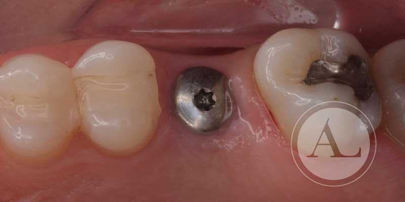 reposición de dientes ausentes Clínica Antonio Lucena