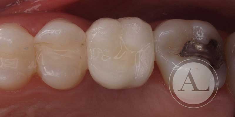 Implante dental Clínica Antonio Lucena