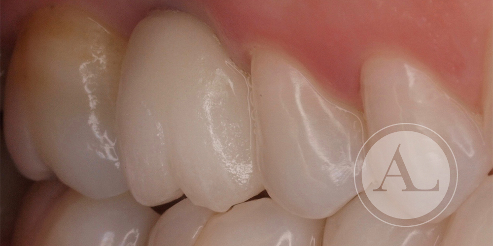 Implantes dentales Clínica Dental Antonio Lucena