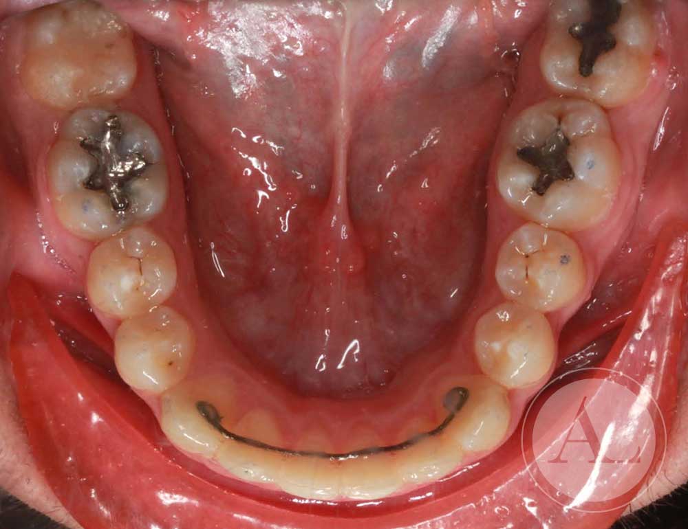 Análisis final ortodoncia Antonio Lucena