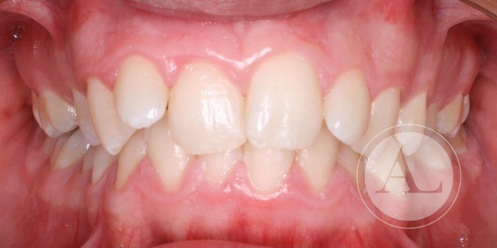 Tratamiento para corregir la posición de los dientes Antonio Lucena