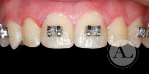 microestética dental Clínica Dental Antonio Lucena