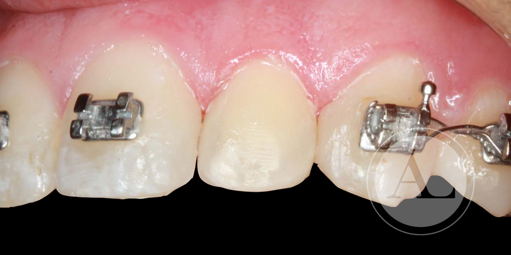 microestética dental Antonio Lucena